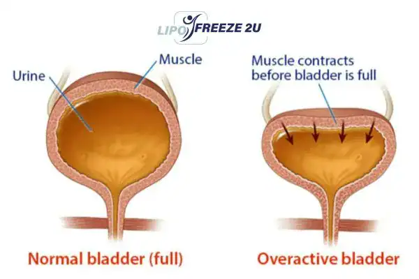 diagram of overactive bladder treatment Gainsborough
