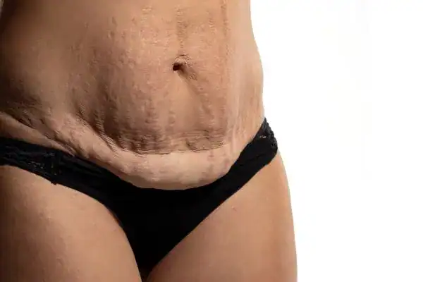 loose skin after weight loss injections Gainsborough