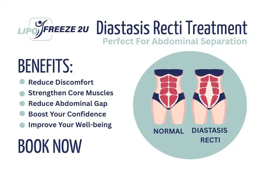 How Long Will It Take to See Improvements in Diastasis Recti Gainsborough