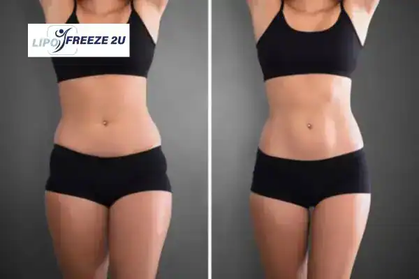How Can LIPO FREEZE 2U Support Your Post-Pregnancy Body Recovery Gainsborough?