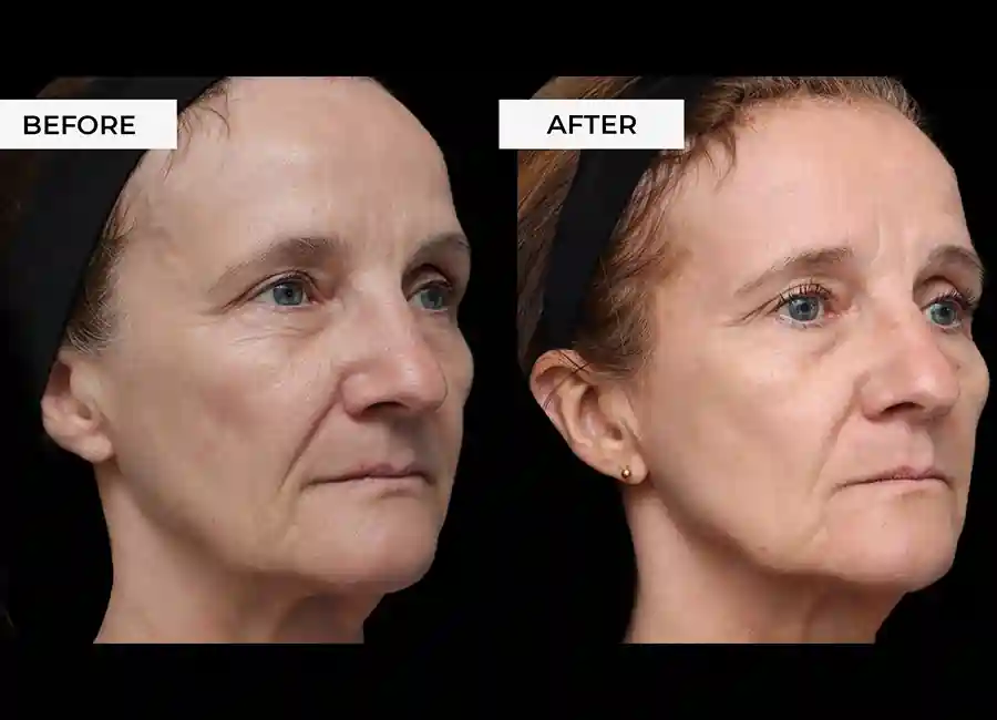 How Many RF Microneedling Sessions Will You Need to See a Difference Gainsborough?