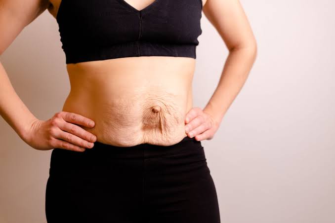 Is Surgery Really the Only Way to Repair Diastasis Recti Gainsborough?