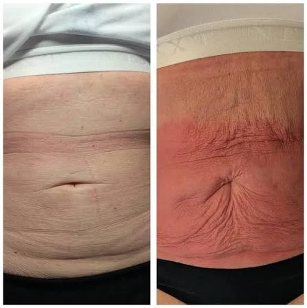 How Does RF Microneedling Improve Crepey, Thin and Uneven Skin Texture Gainsborough?