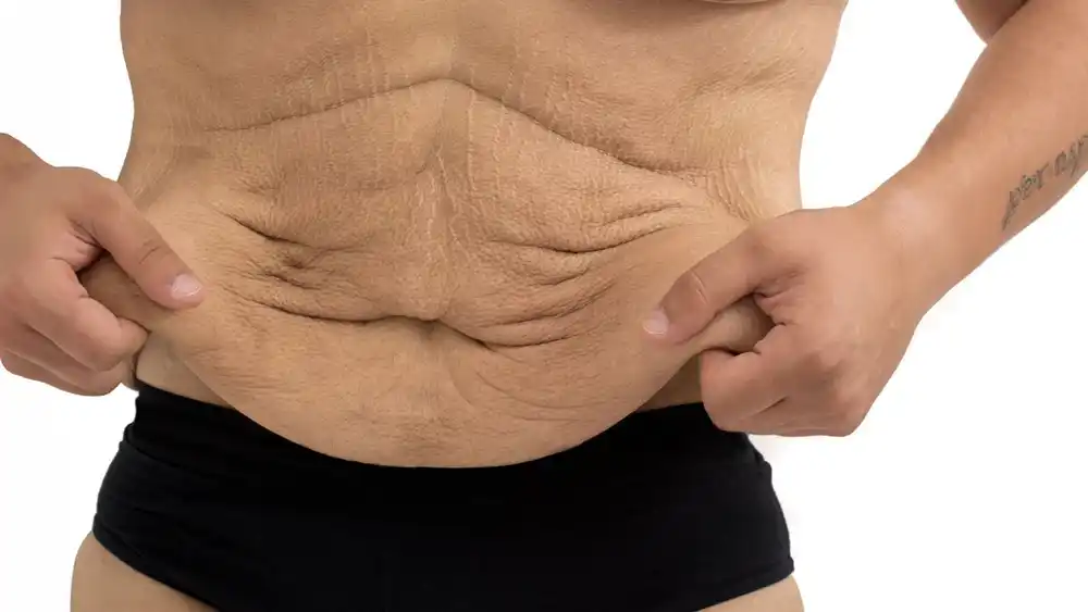 RF Microneedling for Loose Skin: How Can It Help Tighten and Reshape the Skin Gainsborough?